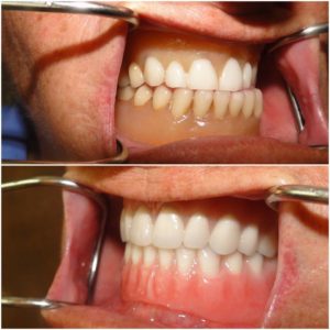 denture-before-after